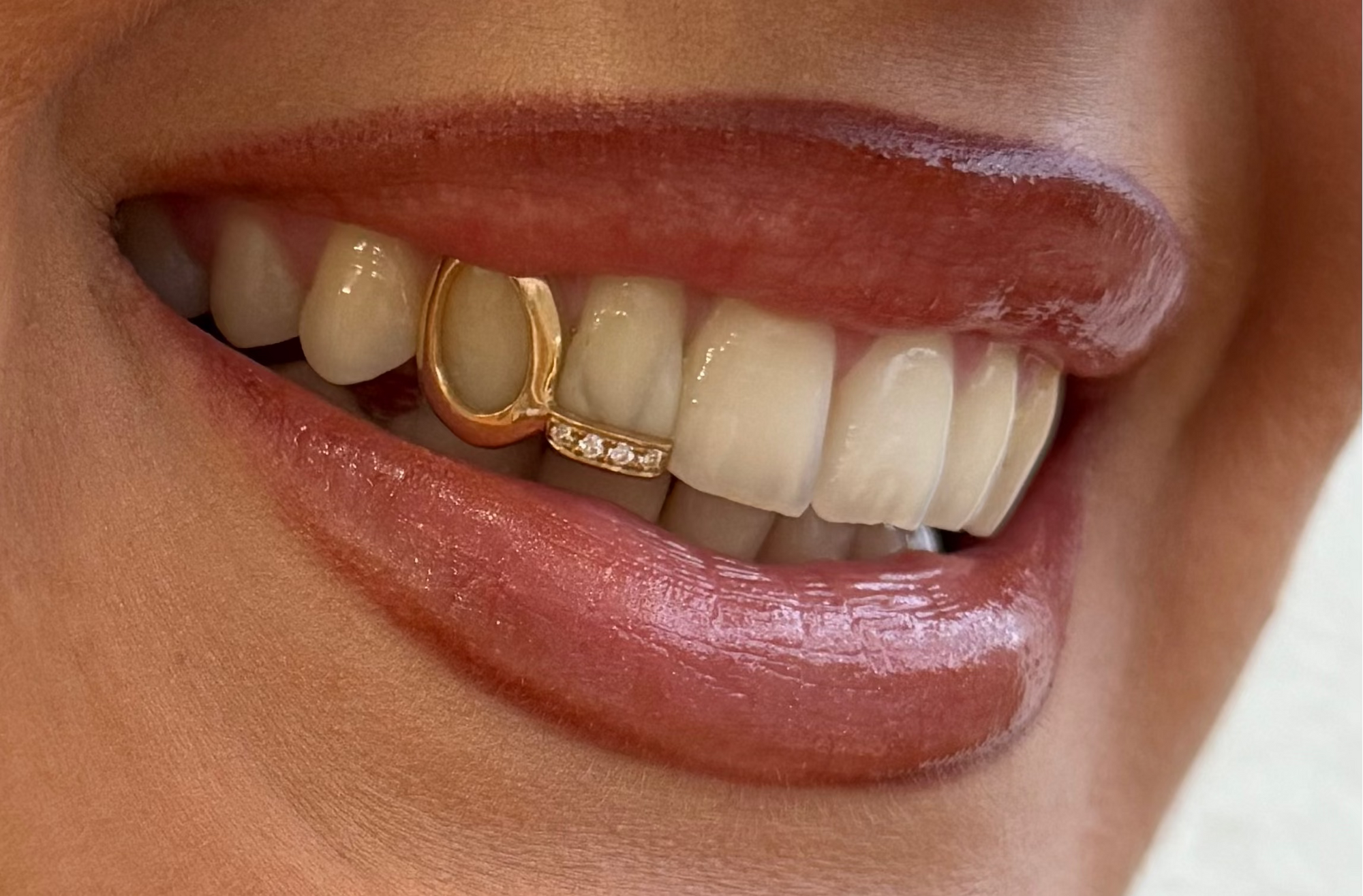 Dent pleine (ou contour) + ligne