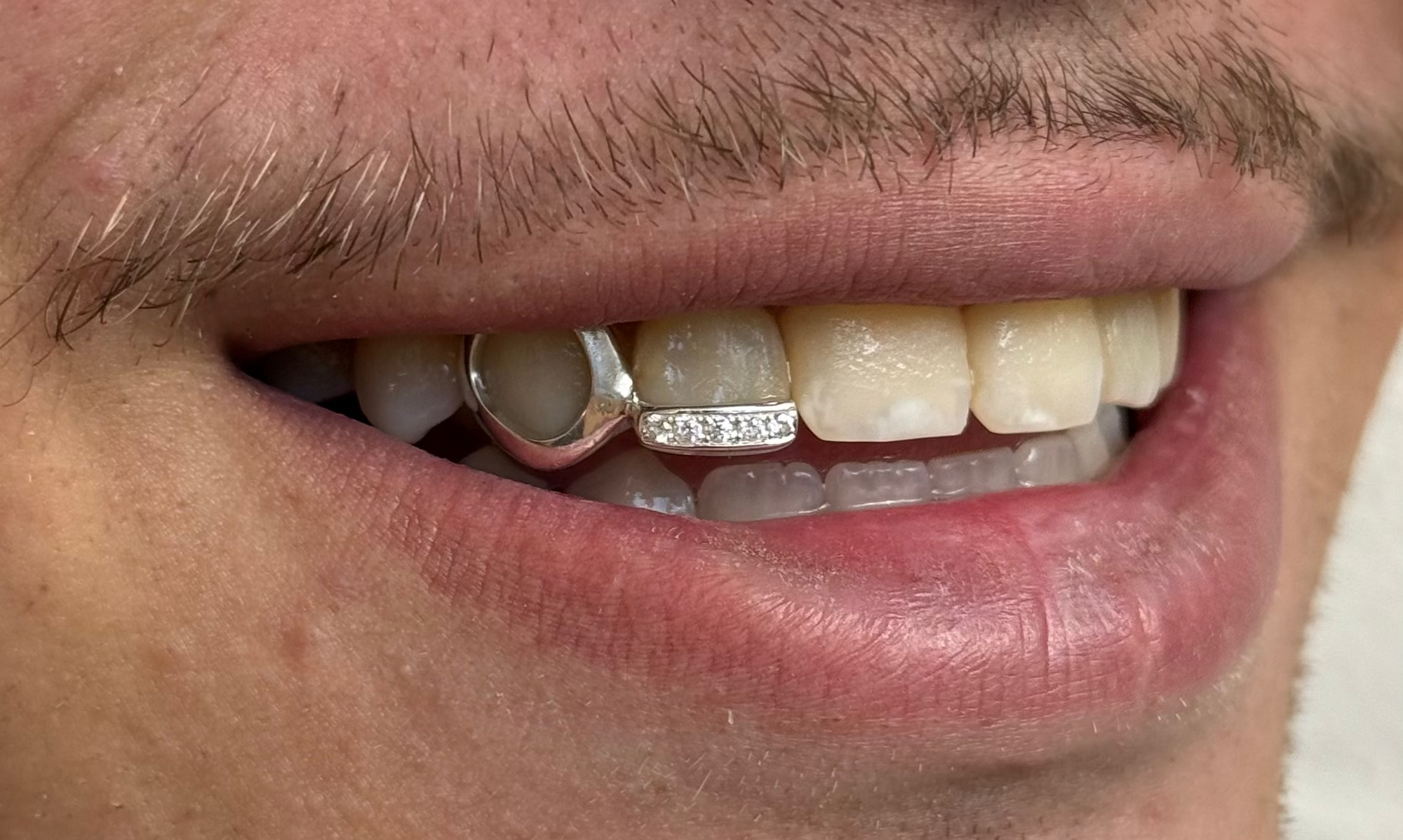 Dent pleine (ou contour) + ligne